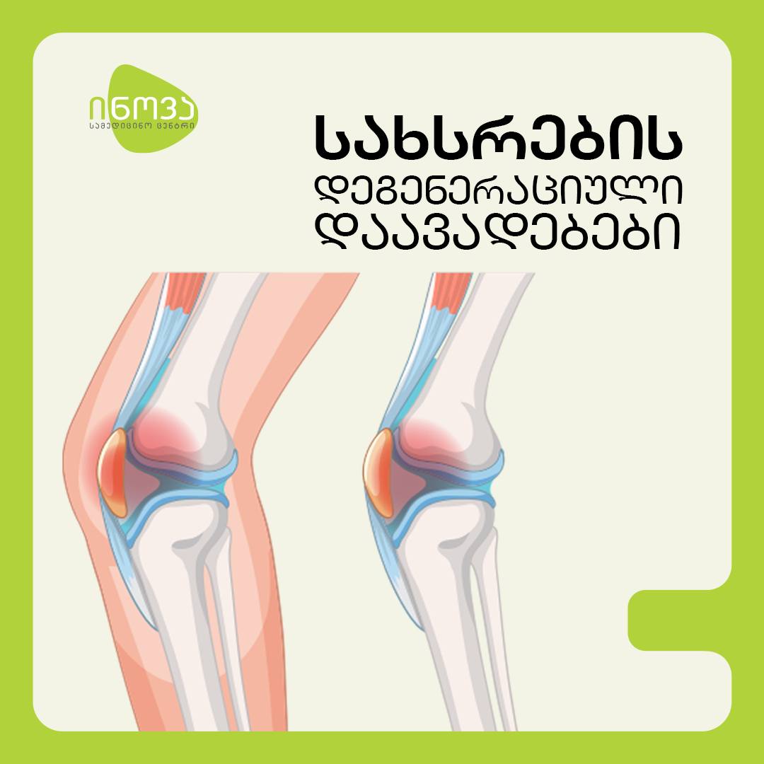 სახსრების დეგენერაციული დაავადებები