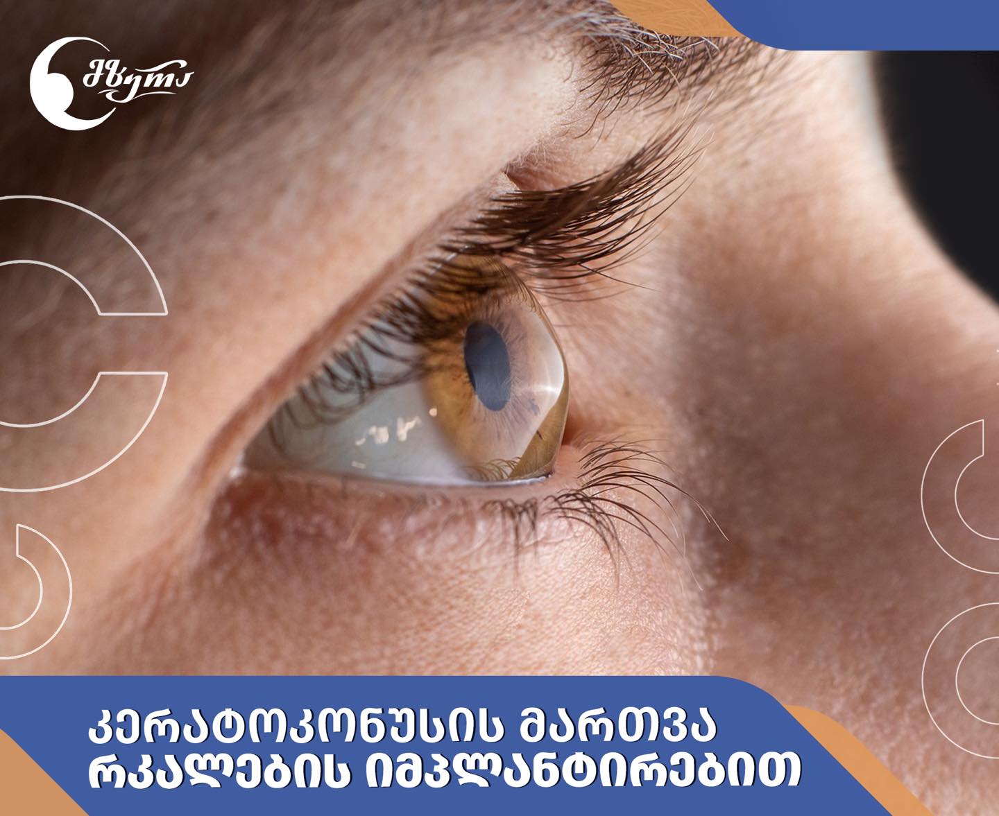 კერატოკონუსის მართვა რკალების იმპლანტირებით