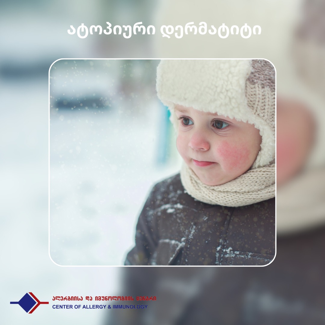 როგორ მოქმედებს ცივი ამინდი კანზე და რატომ მწვავდება ზამთარში ატოპიური დერმატიტი?