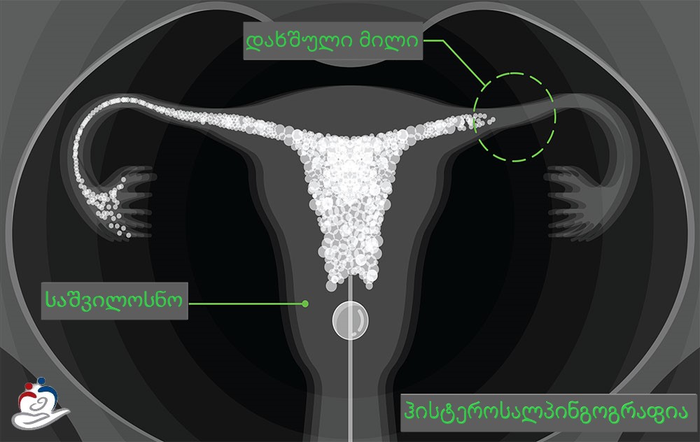 გახსენით გზა დედობისკენ