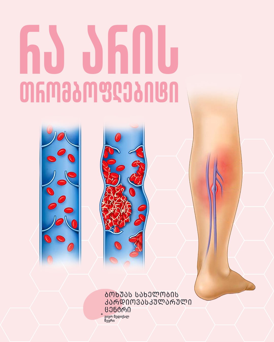 რა არის თრომბოფლებიტი?