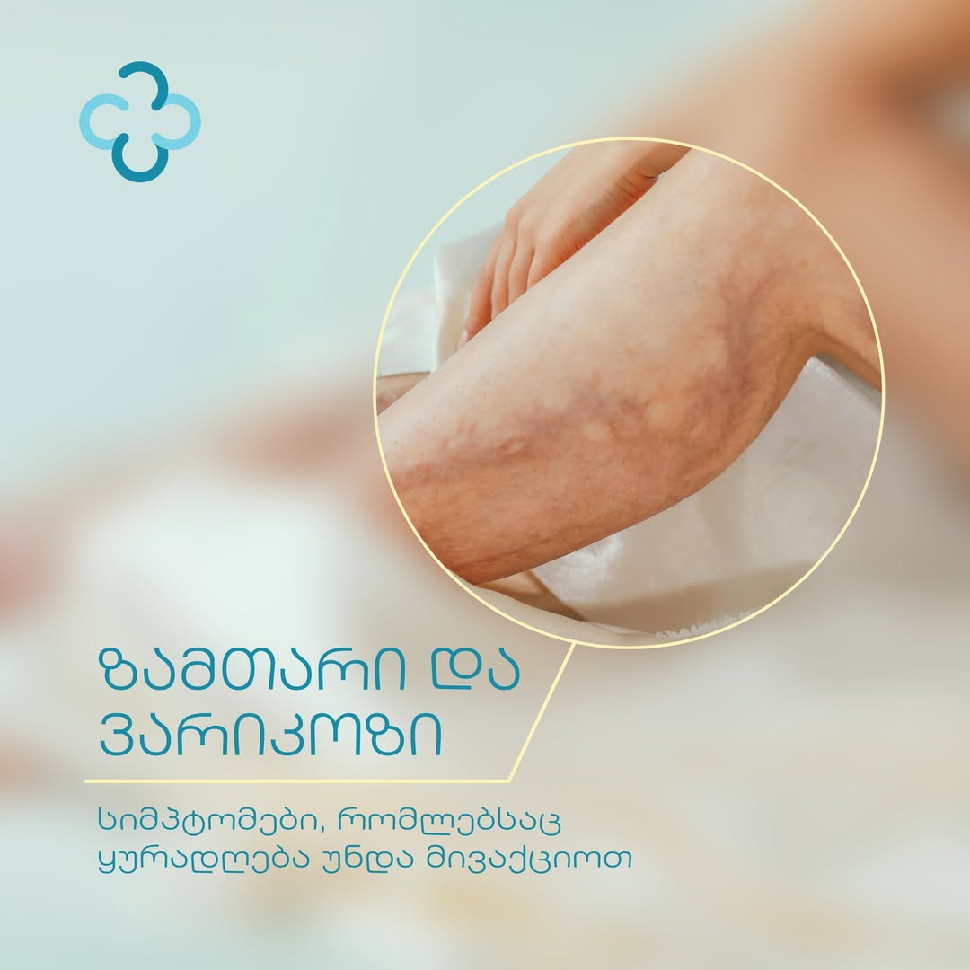 ზამთარი და ვარიკოზი &ndash; სიმპტომები, რომლებსაც განსაკუთრებული ყურადღება უნდა მივაქციოთ!